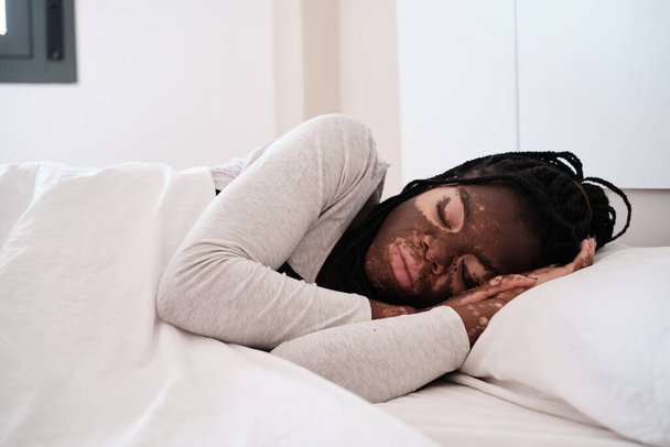 Jeune femme afro-américaine avec vitiligo somnolant dans un lit confortable avec du linge blanc pendant la matinée - Photo, image
