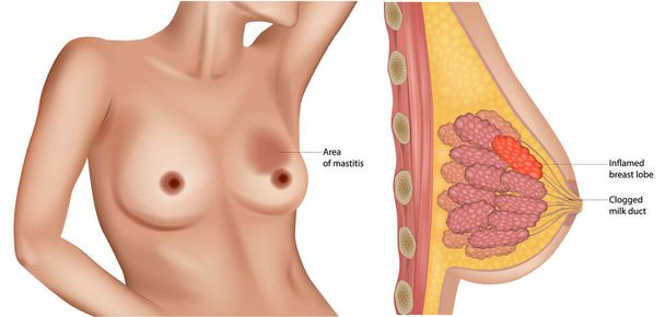 Mastite. Coupe transversale de la glande mammaire avec inflammation du sein. Formation d'abcès. Conduit de lait bloqué. Lobe mammaire enflammé. - Vecteur, image