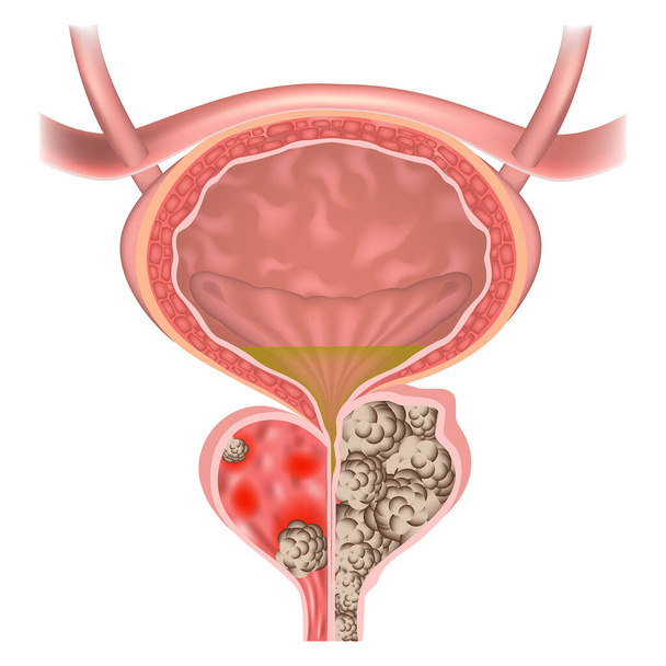 Prostate adenoma. Organ cancer with a lot of stones. Urethral obstruction. Bladder. Vector illustration. - Vector, Image