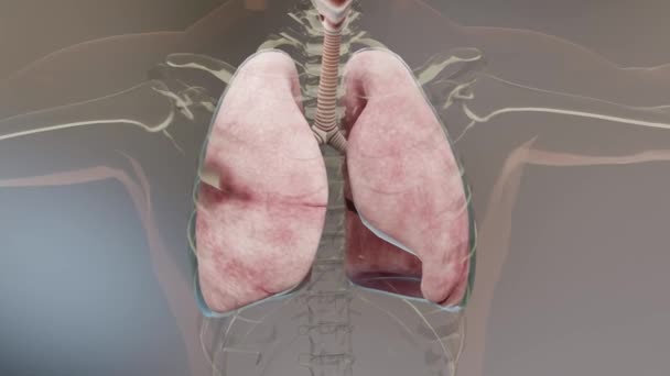 Pneumothorax, Normale Lunge versus Kollaps, Symptome von Pneumothorax, Pleuraerguss, Empyema, Komplikationen nach einer Brustverletzung, Luft im Pleuraraum zwischen Lunge und Brustwand, 3D - Filmmaterial, Video