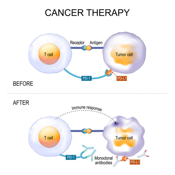 Cancer therapy of monoclonal antibodies. treatment of endometrial cancer, Hodgkin lymphoma, carcinoma, breast and lung tumor. Antibody binds to the PD-1 receptor and block its activity, that prevent tumor cells from bypassing immune response. Vector  - Vector, Image