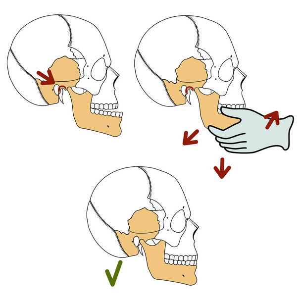 Reduction of the temporomandibular joint. Vector illustration - Vector, Image