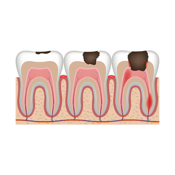 stages of caries. Stages of tooth destruction and pulp inflammation. Illustrative vector diagram - Vector, Image