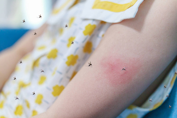 Menina tem alergia erupção cutânea e coceira no braço de picada de mosquito - Foto, Imagem
