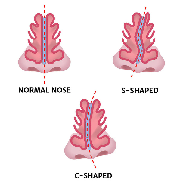Variétés de courbure du nez. Affiche médicale. Illustration vectorielle - Vecteur, image