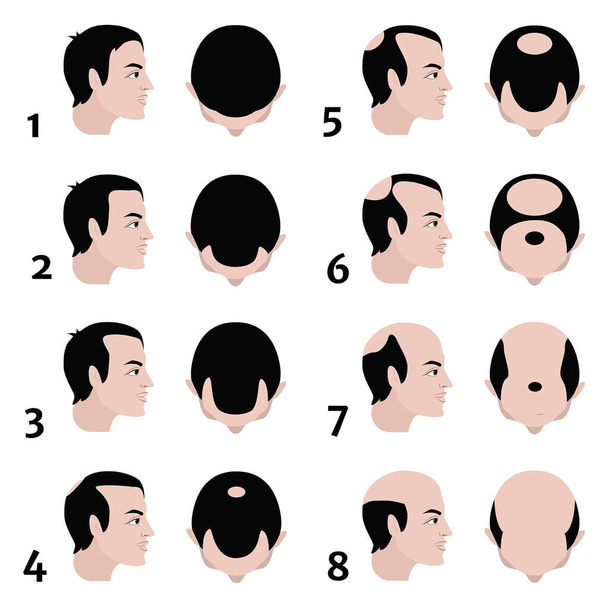 Stages of baldness according to the Norwood scale. Vector flat illustration - Vector, Image