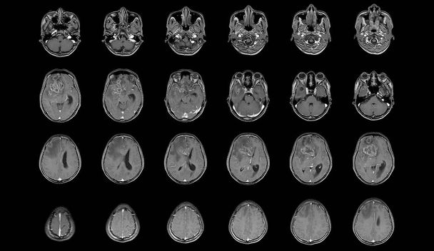 IRM Cerveau Vue axiale .pour évaluer la tumeur cérébrale. Glioblastome, métastase cérébrale masse d'isodensité avec une marge mal définie et œdème environnant au lobe frontal droit. - Photo, image