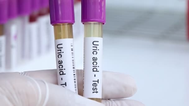 Teste de ácido úrico para procurar anormalidades de urina, amostra de urina para analisar em laboratório, urina em tubo de ensaio - Filmagem, Vídeo