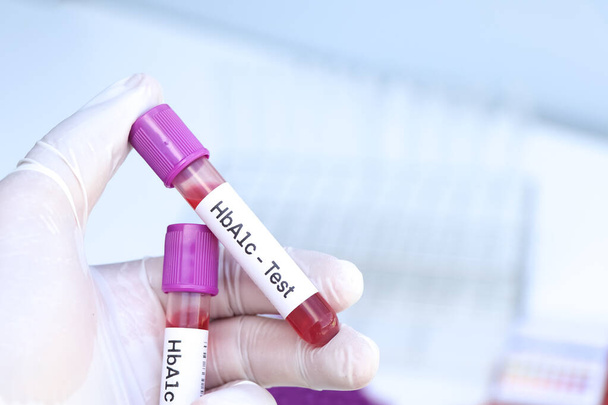 HbA1c test from blood , Blood samples to be analyzed in the laboratory, red blood in test tube  - Foto, immagini
