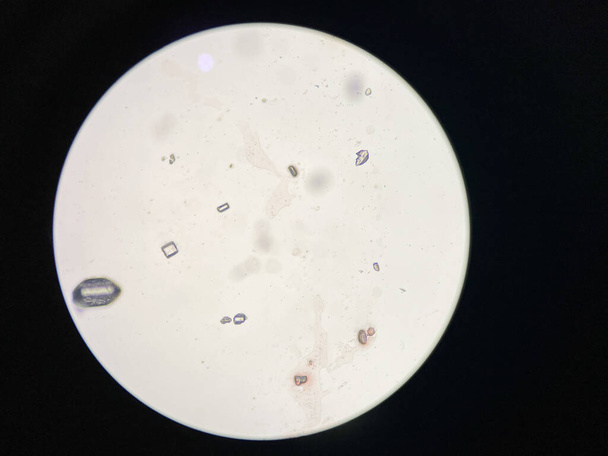 Мікроскопічний погляд на кристали струвіту з сечового осаду. Магнієві амонієві фосфатні кристали
. - Фото, зображення