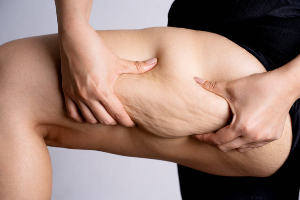 Cellulite leg woman pinch. Test fat hips treatment. Over weight liposuction.  - Foto, Imagem