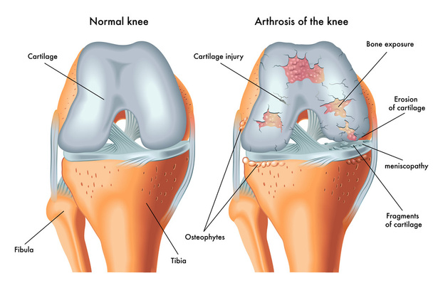 Artrosis humana de rodilla
 - Vector, Imagen