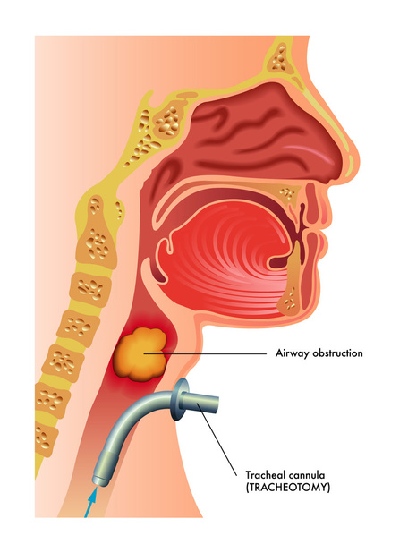 Traqueotomía humana detallada
 - Vector, Imagen