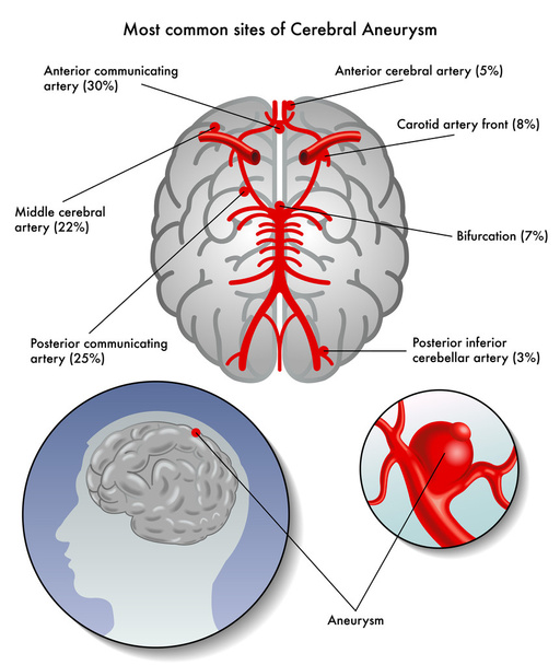 Sites van cerebrale aneurysma - Vector, afbeelding