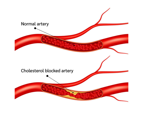 Flusso sanguigno normale e trombosi dell'arteria di colesterolo malattia microvascolare. Nei vasi sanguigni umani. Alto livello ldl e hdl. Arteriosclerosi rischio di sangue. Illustrazione vettoriale 3D. - Vettoriali, immagini
