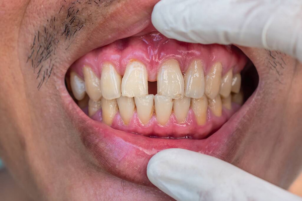 Hatalmas szakadék van az ázsiai kínai férfi első fogai vagy metszőfogai között. Diasztéma. - Fotó, kép