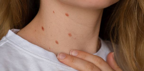 Felismerhetetlen nő mutatja anyajegyek a nyak bőrén Közelkép a csupasz bőr Nap Expozíció hatása a bőrre, egészségügyi hatásai UV sugárzás Nő anyajegyek pigmentáció és sok - Fotó, kép