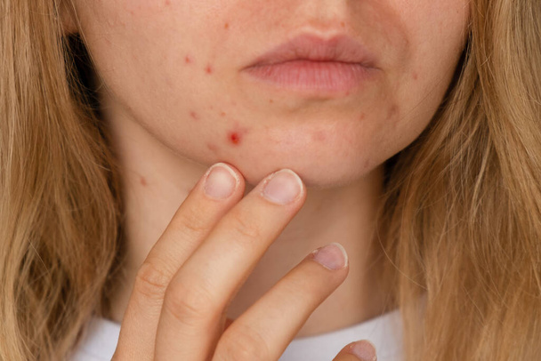 Onherkenbare vrouw die haar acne op het gezicht laat zien. Close-up acne op vrouwen gezicht met huiduitslag huid, litteken en plek die allergisch zijn voor cosmetica. Probleem huidverzorging en gezondheid concept. Rimpels, melasma, donker - Foto, afbeelding