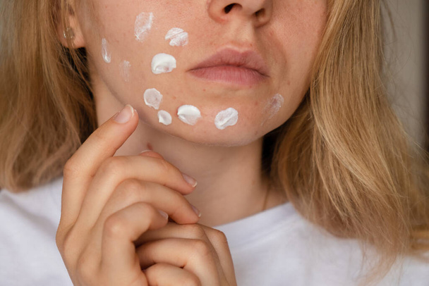 Unrecognizable woman applies makeup, cream serum cure for acne on face. Close-up acne on womans face with rash skin ,scar and spot that allergic to cosmetics. Problem skincare and health concept - Photo, Image