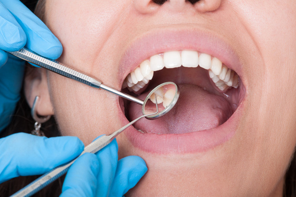 Zahnarzt Werkzeuge und Mund offen mit schönen Zähnen - Foto, Bild