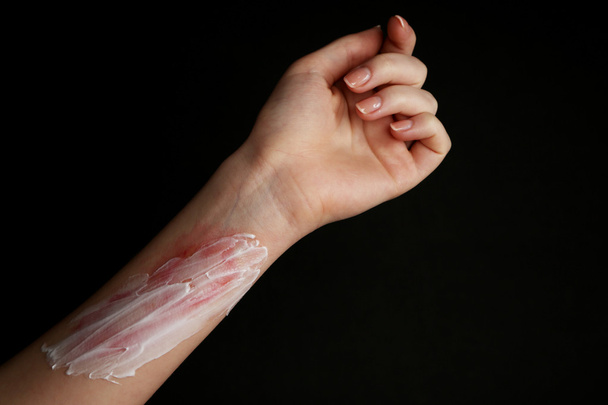 Treatment of burns on female hand on black background - Photo, image