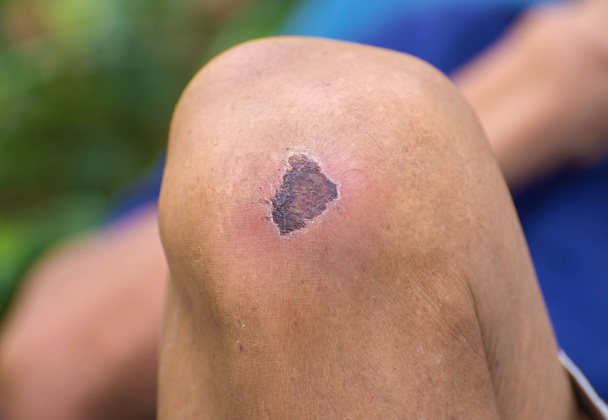 Suszonych rany na kolana - Zdjęcie, obraz