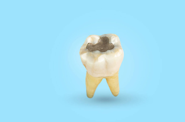  Makro zubu obsahujícího amalgám. Zubní kaz a zubní kaz s kalkulem. světle modré pozadí. Pohled zepředu. Zubní kaz a zubní kaz se začíná rozpadat. - Fotografie, Obrázek