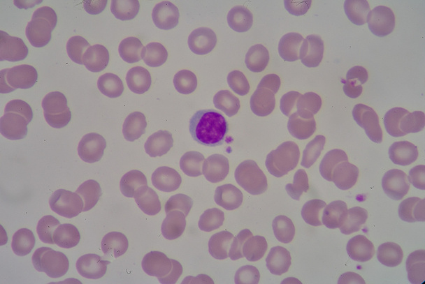 linfocitário
 - Foto, Imagem
