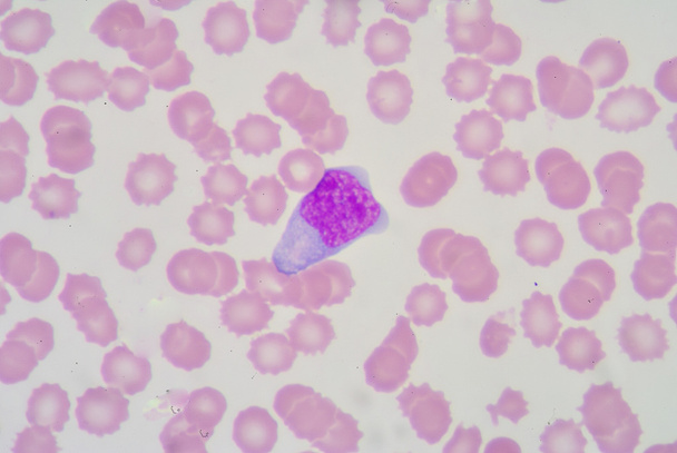 Linfocitos atípicos
 - Foto, imagen