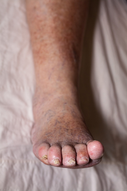 Senior láb problémák - Fotó, kép