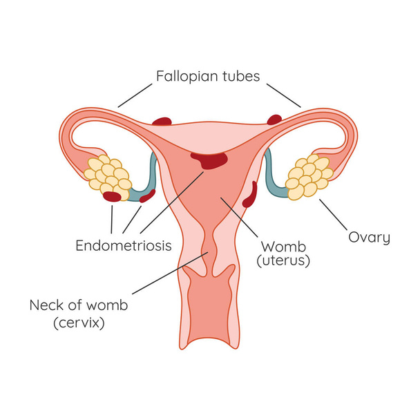 Endometriosis. The appearance of the disease endometriosis. Endometrium. Infographic - Photo, Image
