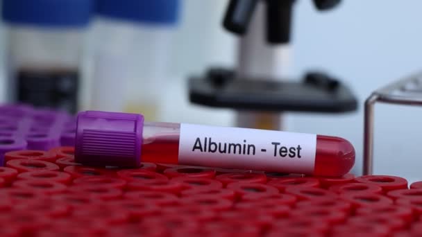 Δοκιμή αλβουμίνης για να ψάξουν για ανωμαλίες από το αίμα, δείγμα αίματος για να αναλύσει στο εργαστήριο, αίμα σε δοκιμαστικό σωλήνα - Πλάνα, βίντεο