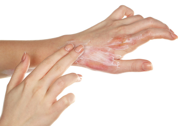Treatment of burns on female hand isolated on white - Фото, изображение