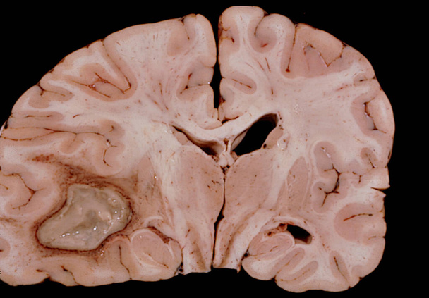 Coupe coronale à travers un cerveau humain au niveau du thalamus montrant un gros abcès, probablement d'origine bactérienne, situé dans le lobe temporal. La croissance de l'abcès produit une déviation du ventricule latéral. - Photo, image