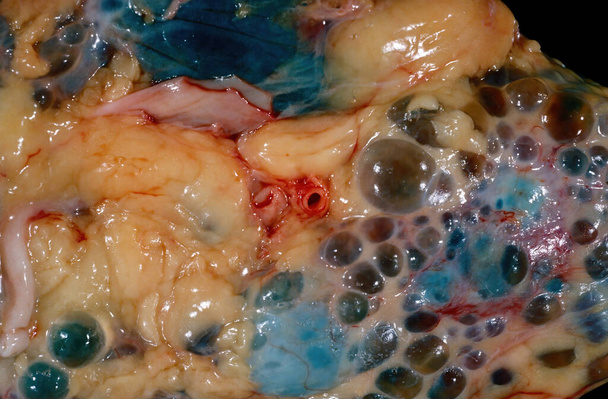 Close-up de uma amostra grosseira mostrando a superfície de um rim humano em um caso de doença renal policística autossômica dominante (ADPKD). A superfície está cheia de grandes cistos. ADPKD é causada por mutações em genes PKD que produzem um prote anormal específico - Foto, Imagem