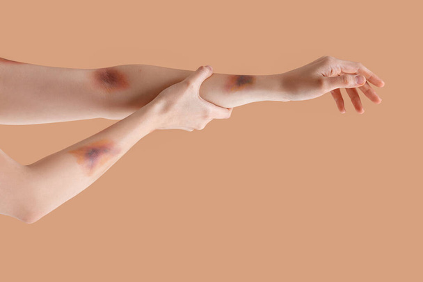 Mani femminili ammaccate su sfondo beige - Foto, immagini