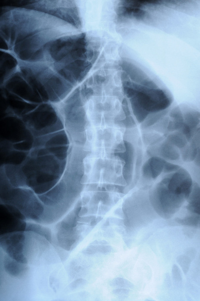 röntgenkuva ihmisen selkärangan
 - Valokuva, kuva