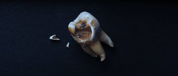 La carie dentaire sur fond noir. Macro shot d'une carie dentaire jusqu'à la racine après extraction du dentiste. Véritable anatomie dentaire due à un manque de soin. Vue du dessus de la texture des dents de carie sur papier noir. Soins dentaires. - Photo, image