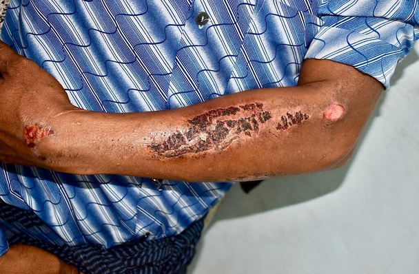 Abrasions guéries par des croûtes à l'avant-bras d'un patient asiatique de sexe masculin. - Photo, image