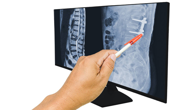 医師は、腰椎圧縮骨折のMRIスキャンを報告しましたL1-L2の膨らみ.鉄棒やネジで固定されたポスト操作。医学教育の概念. - 写真・画像