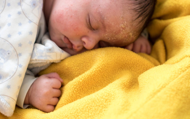 Новорожденный симпатичный ребенок с дерматитом лица; медицинская и педиатрическая концепция - Фото, изображение