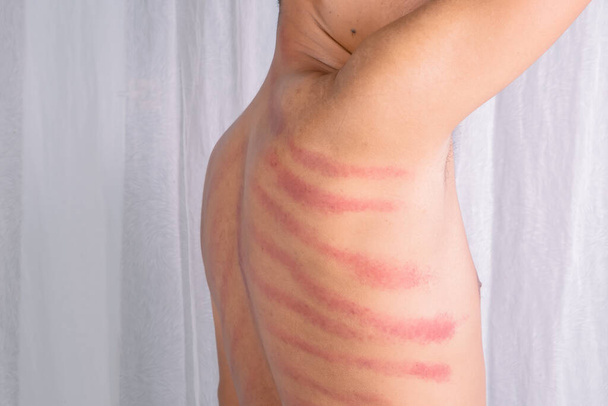 Punaisen jäljen miehen selässä aiheutti Gua Sha. Gua sha on luonnollinen vaihtoehto hoito parantaa verenkiertoa tai parantaa kylmiä oireita - Valokuva, kuva