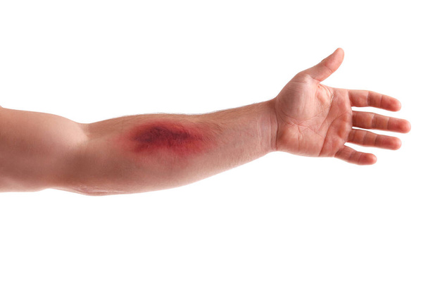 Male arm with bruise on white background - Fotó, kép