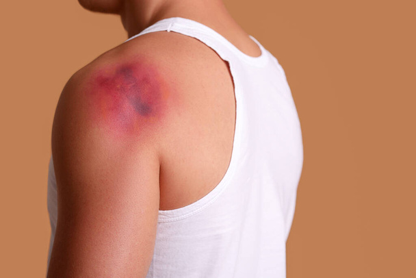 Man with bruise on shoulder against beige background, closeup - Fotó, kép