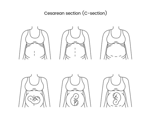 καισαρική τομή προβολές εικονίδιο γραμμή στο διάνυσμα, απεικόνιση μιας εγκύου γυναίκας - Διάνυσμα, εικόνα