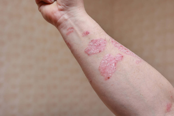 Man met zieke arm, droge schilferige huid op zijn hand met vulgaire psoriasis zweren, allergie, eczeem en andere huidziekten zoals schimmel, plaque, uitslag en vlekken. Auto-immuunziekte - Foto, afbeelding