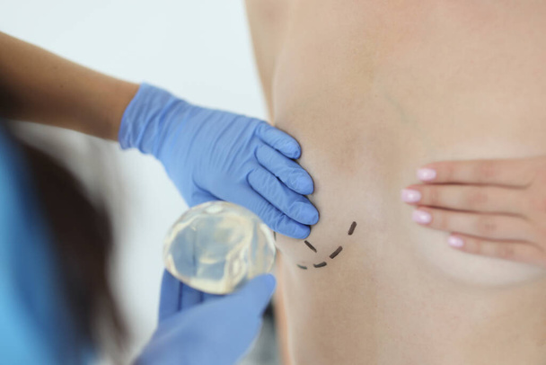 Surgeon holds silicone implant for breast augmentation. Restoration of the breast in women after partial or complete removal oncology concept - Photo, image
