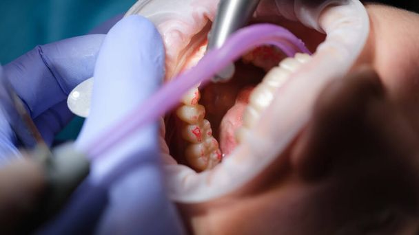 Οδοντίατρος προετοιμάζει τα δόντια των γυναικών για την εγκατάσταση των κεραμικών καπλαμάδων και κορώνες χρησιμοποιώντας τρυπάνι. Γιατρός αφαιρεί μέρος του σμάλτο των δοντιών - Φωτογραφία, εικόνα