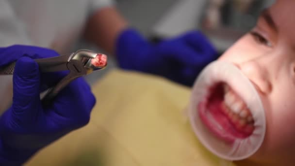 Focus on a freshly removed molar baby tooth in stainless steel forceps, in a dental surgeons hands, against a blurred background of a child with a retractor in his mouth, sitting on a dentists chair - Materiaali, video