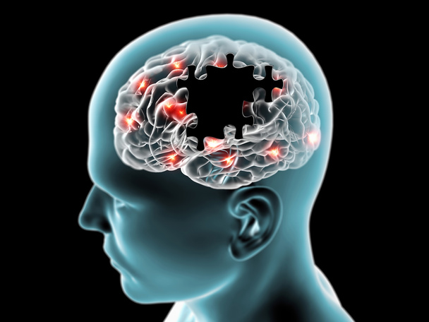 Enfermedades degenerativas cerebrales Parkinson
 - Foto, Imagen